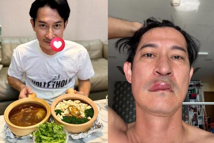 Huy Khánh bất ngờ hé lộ tình trạng sức khỏe sau scandal môi sưng